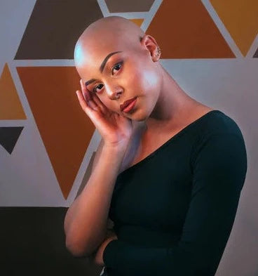 3 Ways to Handle Alopecia as Women